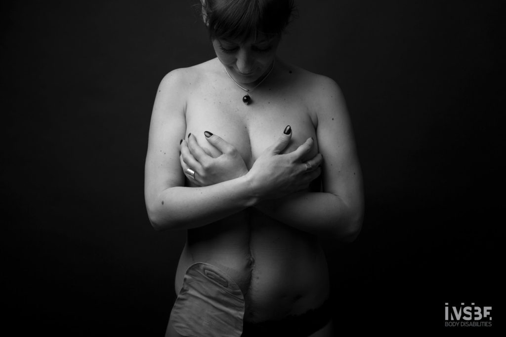 donna con stomia