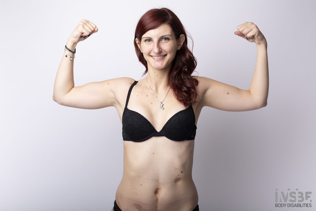 donna che mostra le braccia forti - Invisible Body Disabilities