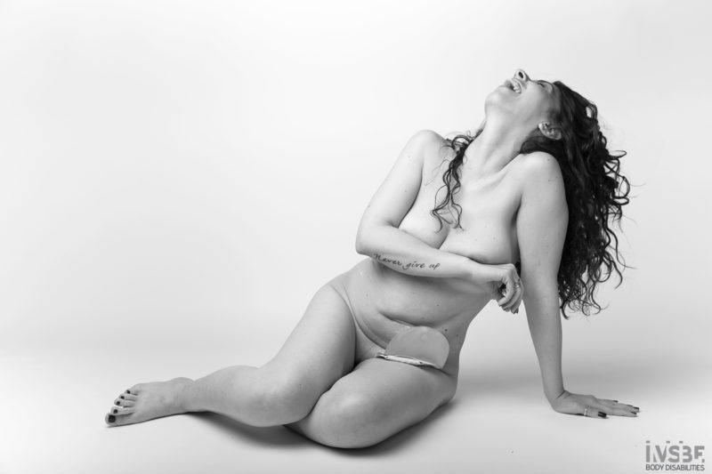 Una donna con colite ulcerosa stomia