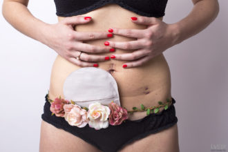 Pancia di una donna con la colite ulcerosa stomia ostomy
