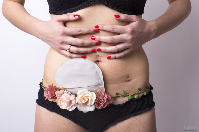 Pancia di una donna con la colite ulcerosa stomia ostomy